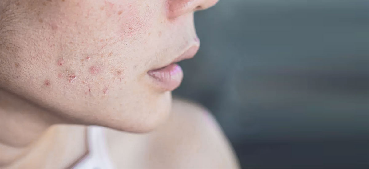 traitement-acne-Depilinea