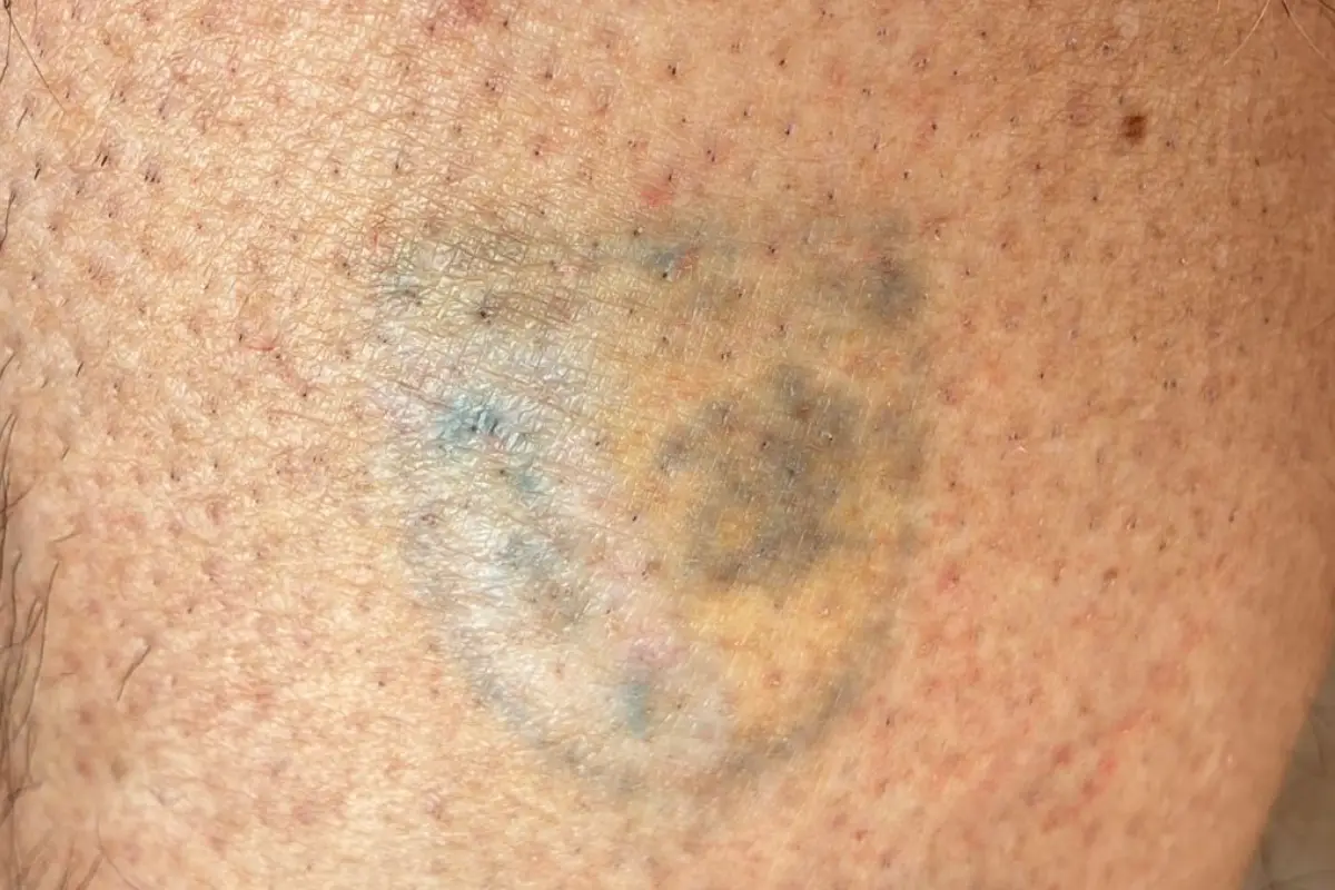 detatouage apres logo detatouage apres logo