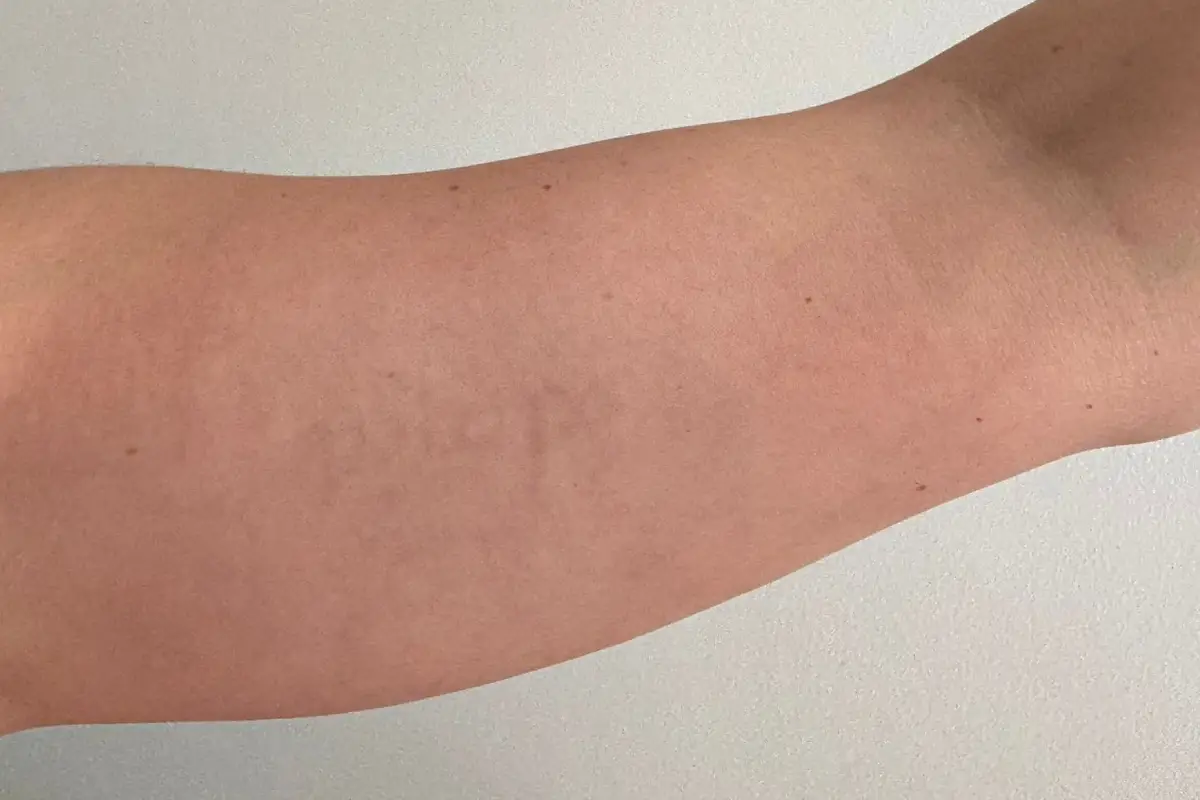 detatouage apres detatouage apres