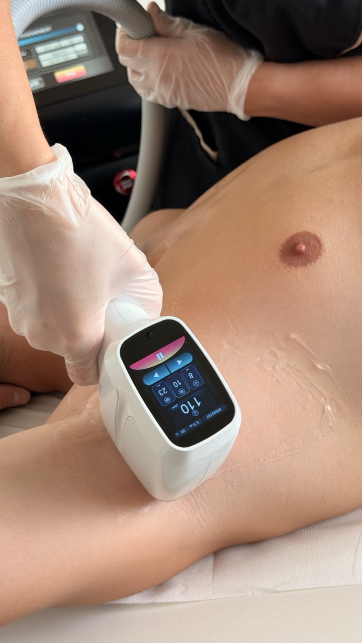 epilation laser aisselles homme