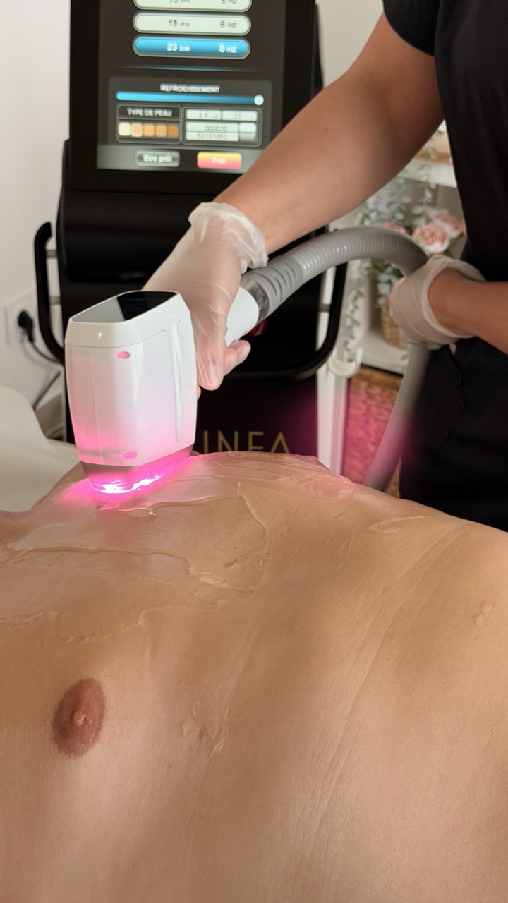 epilation laser torse homme